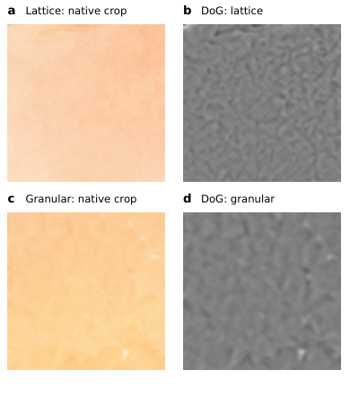 Figure 2: Lattice 및 granular artifact 진단